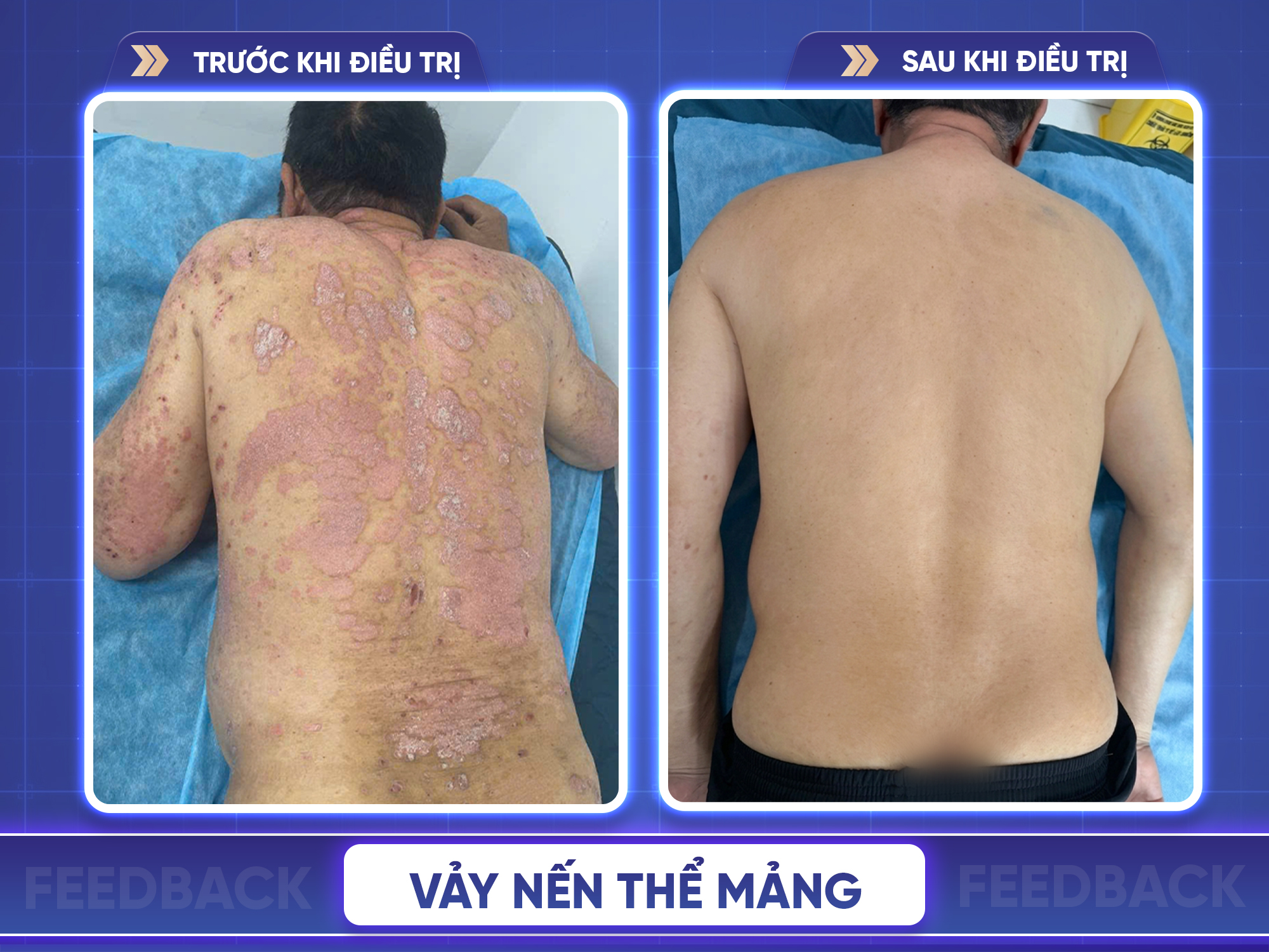 Kết quả trước và sau điều trị vảy nến