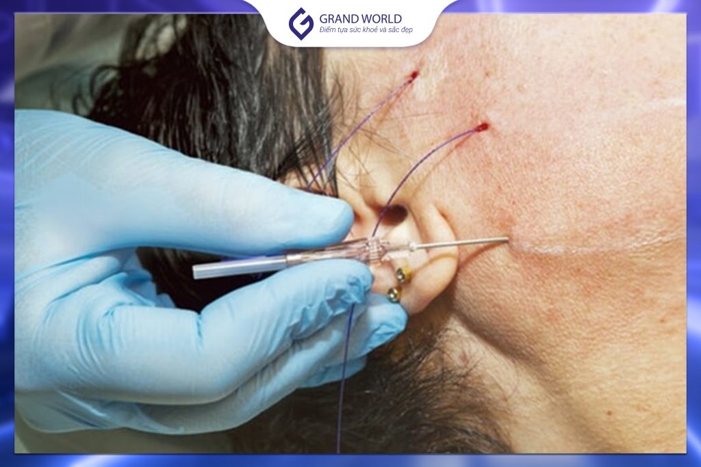 Căng chỉ sinh học là kỹ thuật thẩm mỹ nội khoa ít xâm lấn, đưa chỉ tự tiêu vào lớp dưới da