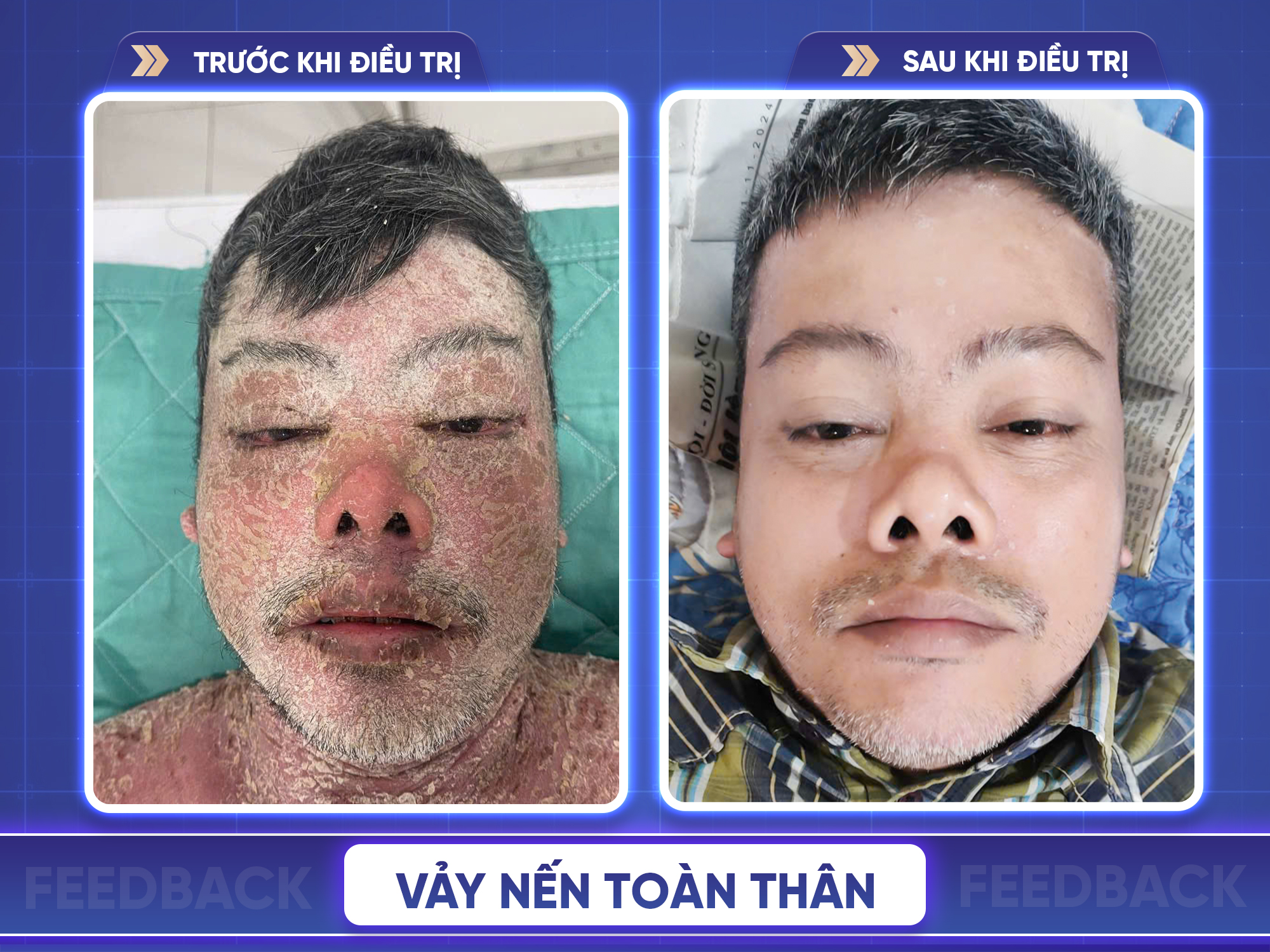 Trước sau