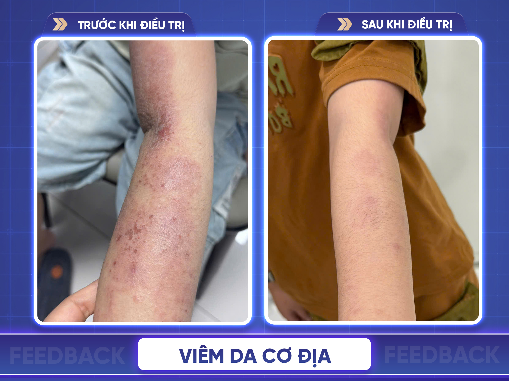 Kết quả trước và sau điều trị viêm da cơ địa