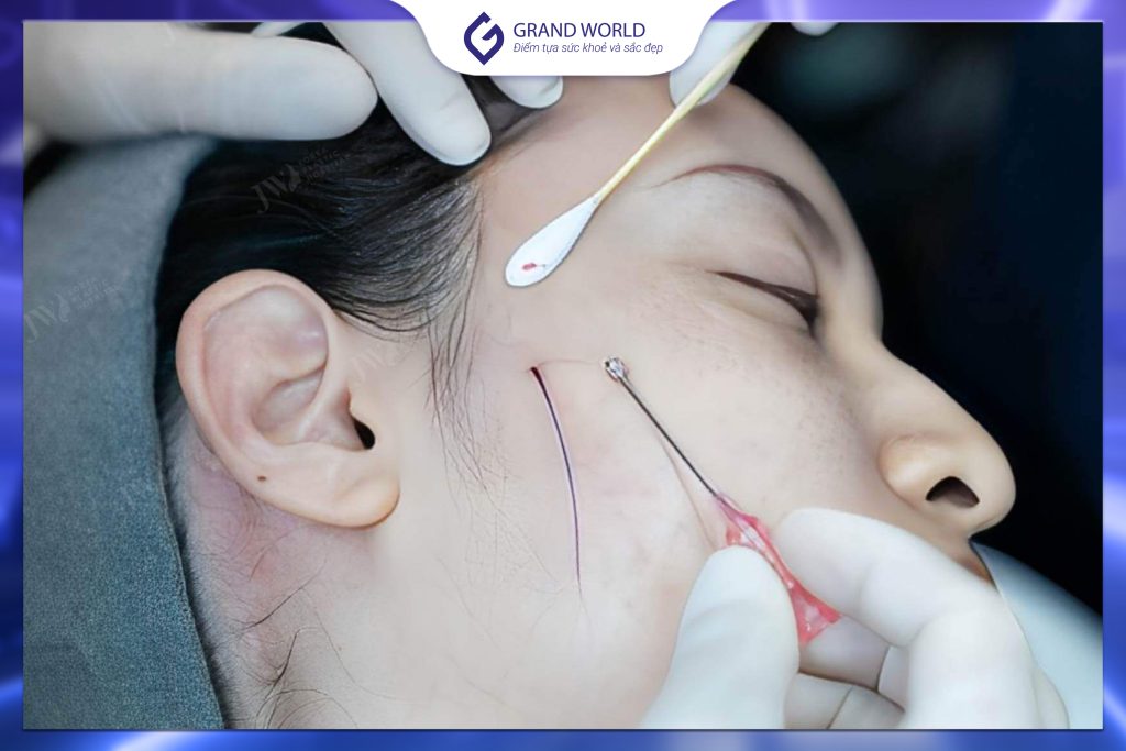 Hiệu quả căng chỉ sinh học mang tính tạm thời và khác nhau tùy từng người