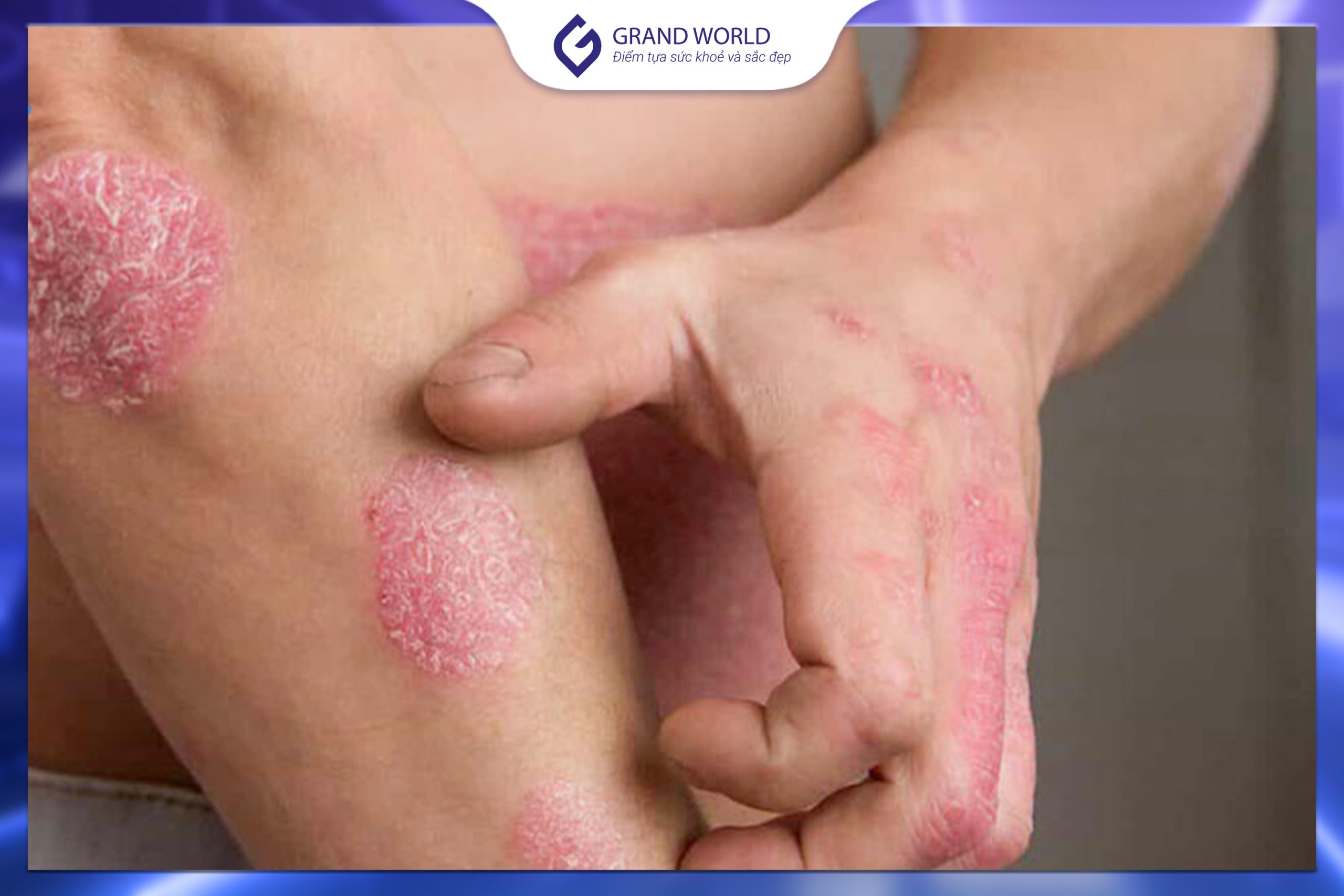 Triệu chứng vảy nến