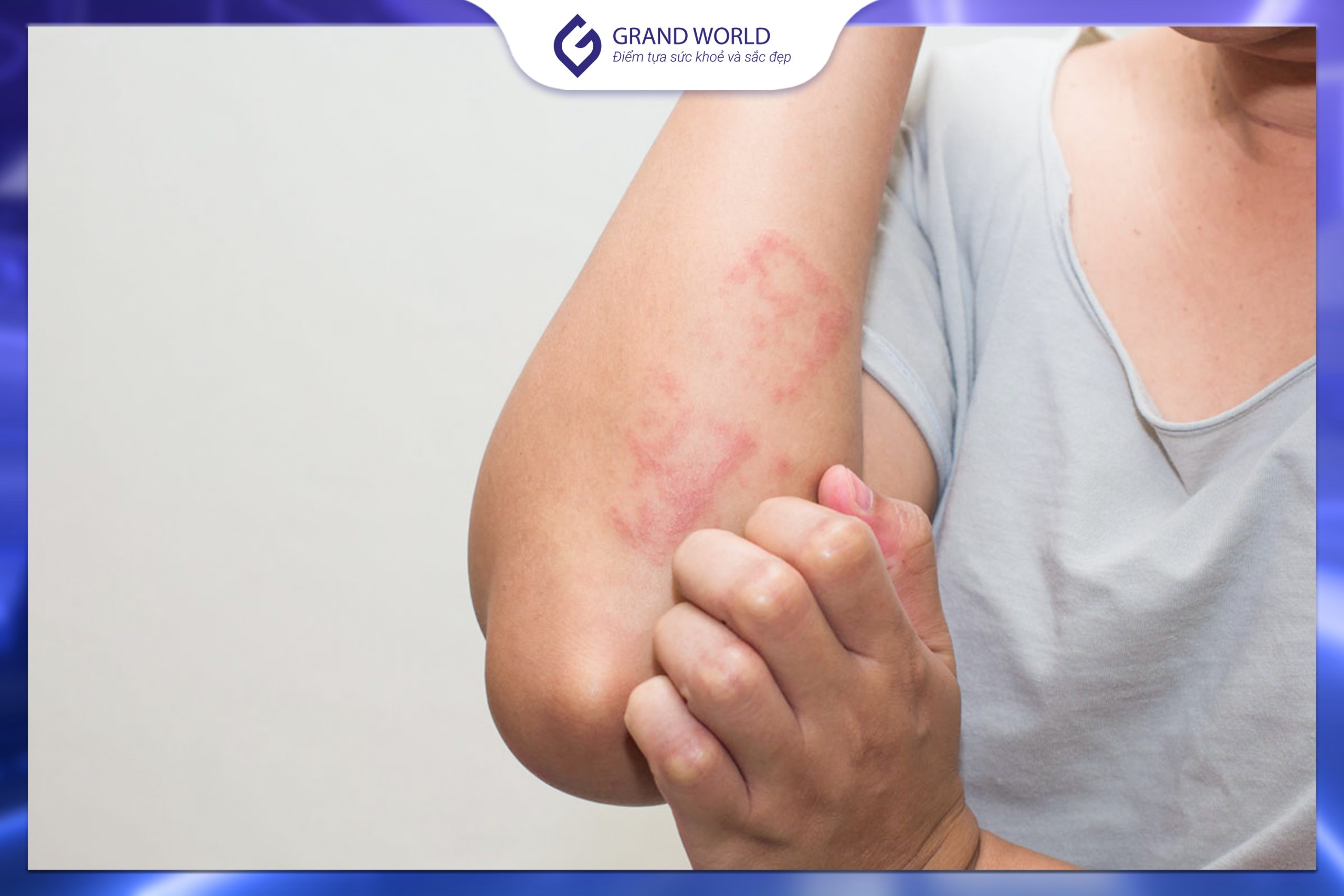 Triệu chứng viêm da cơ địa