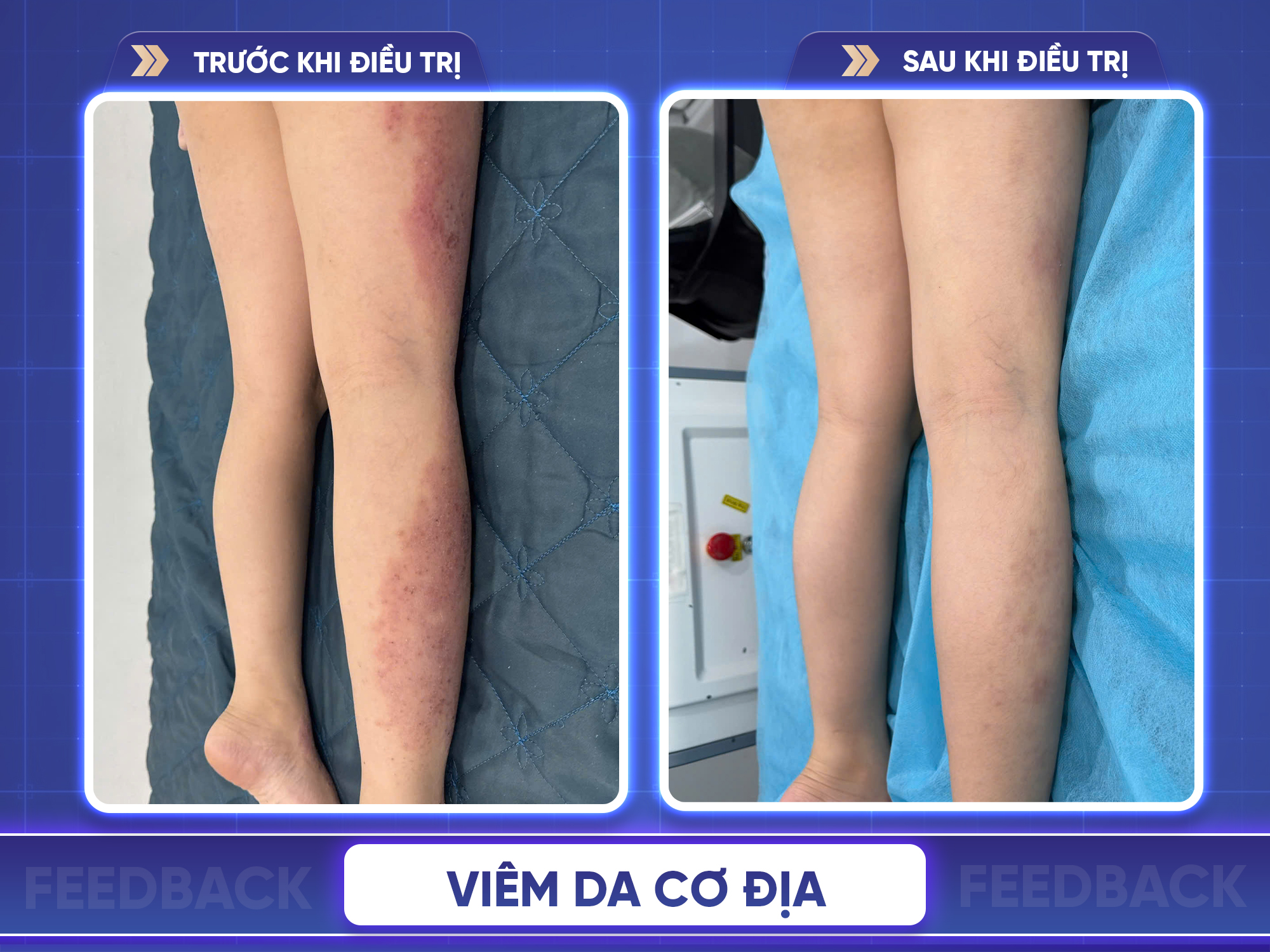 Kết quả trước và sau điều trị viêm da cơ địa
