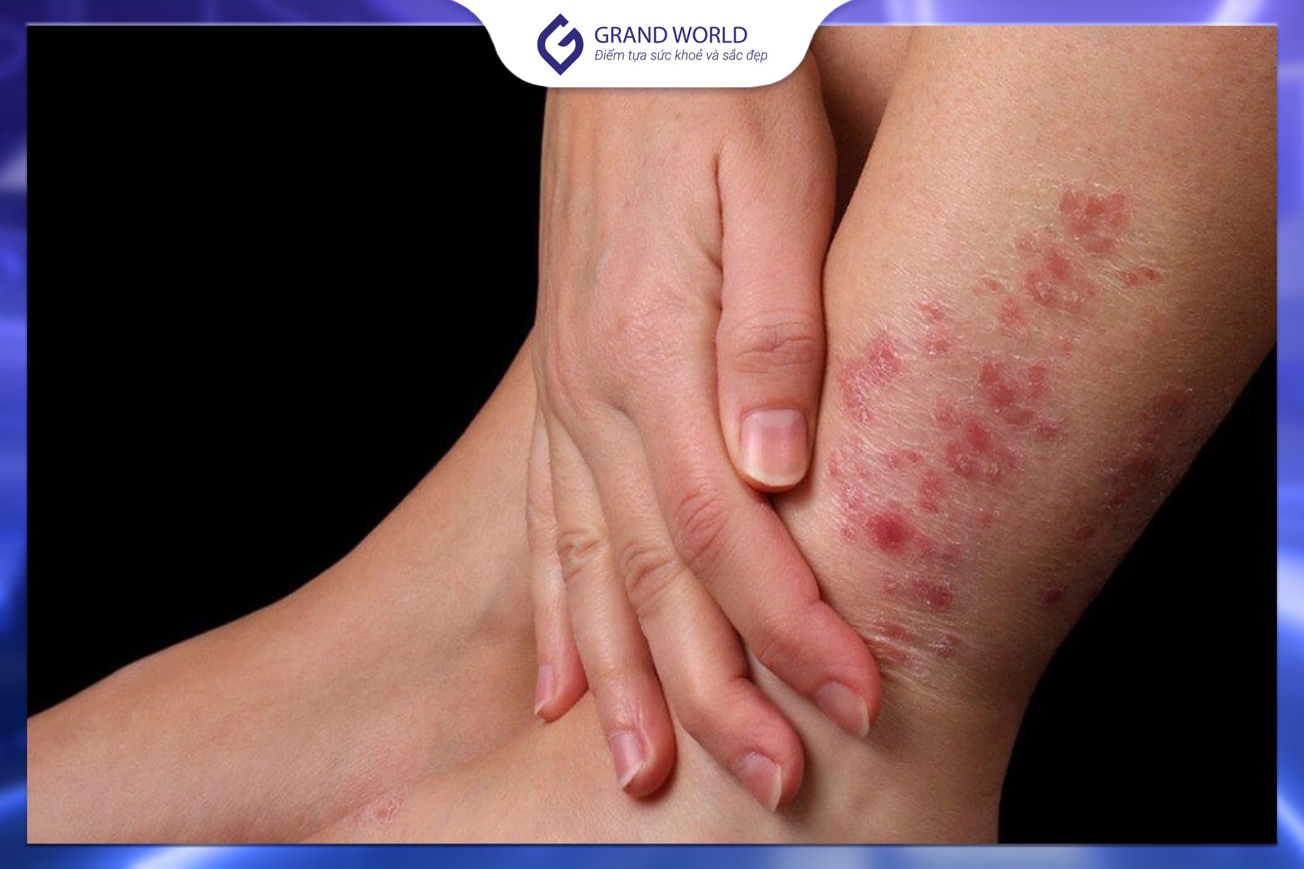 Nguyên nhân lây nhiễm nấm da