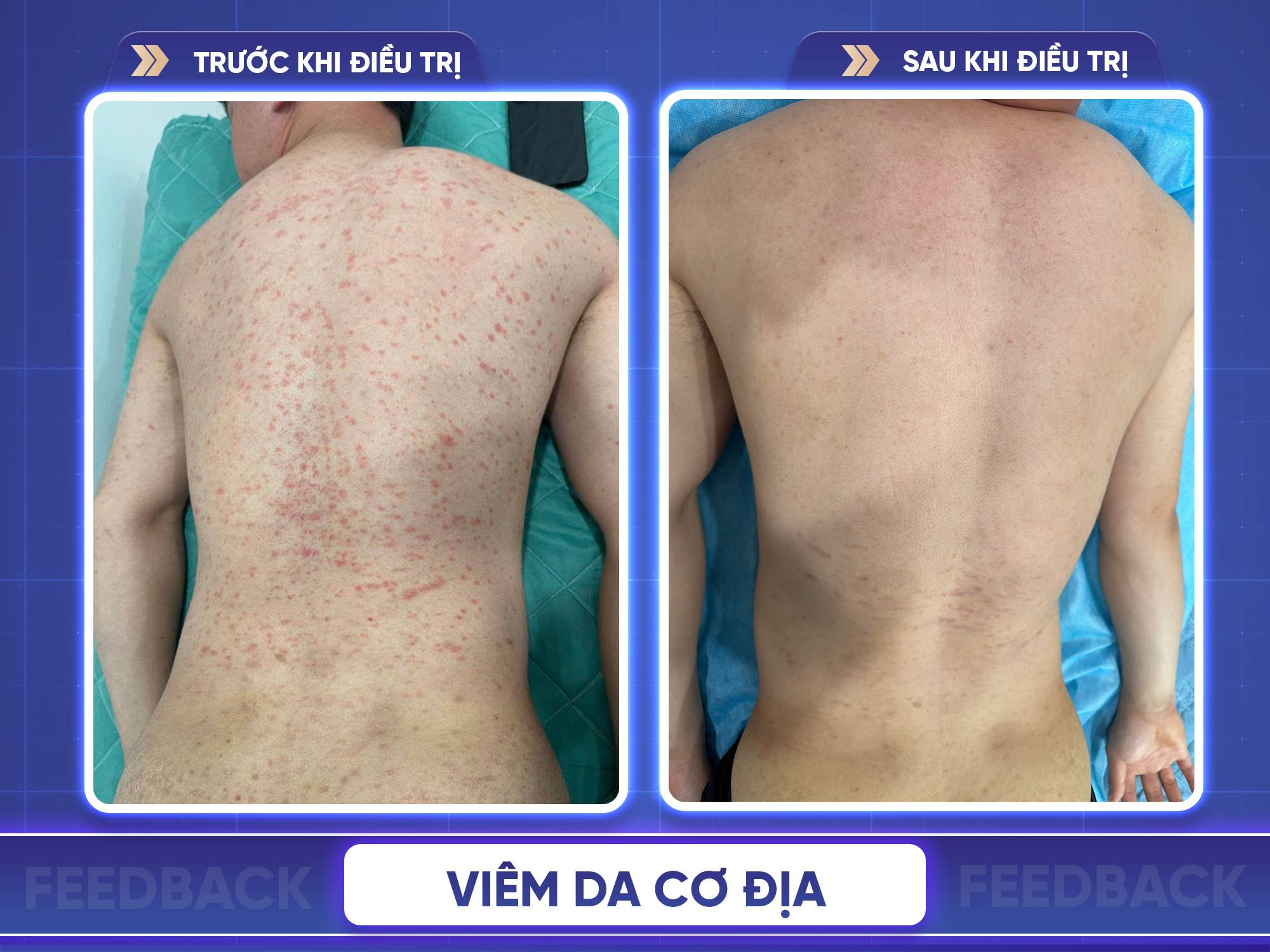 Trước sau