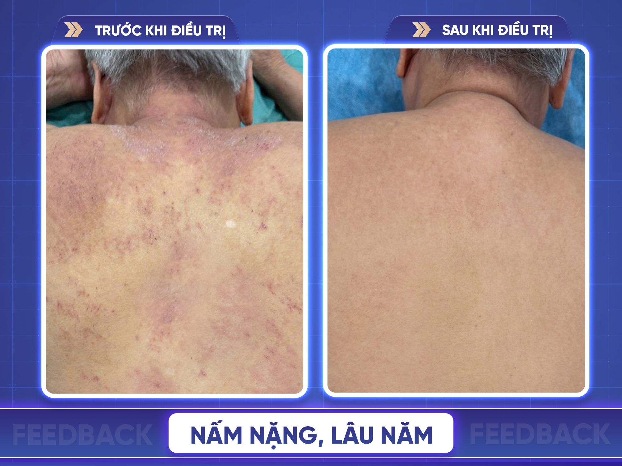 Kết quả trước và sau điều trị nấm da