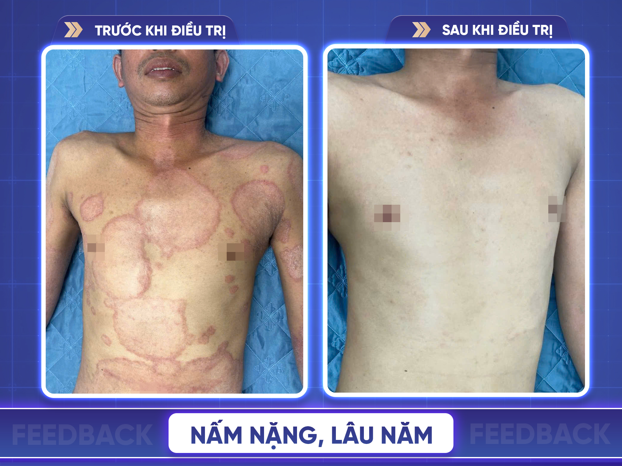 Kết quả trước và sau điều trị nấm da