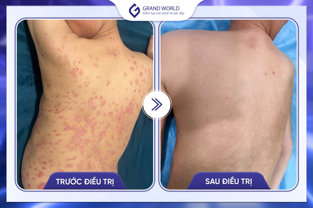 Hình ảnh trước và sau điều trị tại Grand World 1