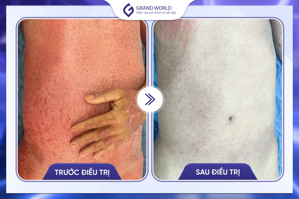 Hình ảnh trước và sau điều trị tại Grand World 2