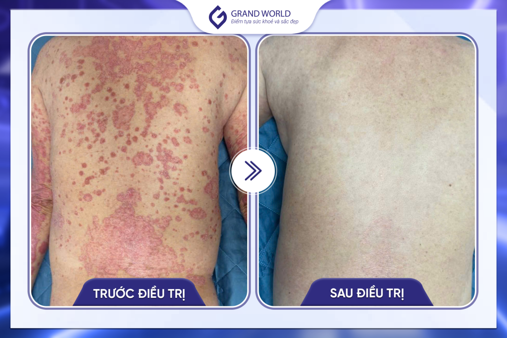 Hình ảnh trước và sau điều trị tại Grand World 3