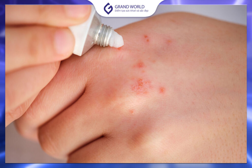 Thuốc bôi chứa corticoid được dùng cho tổn thương vảy nến khu trú, theo chỉ định của bác sĩ