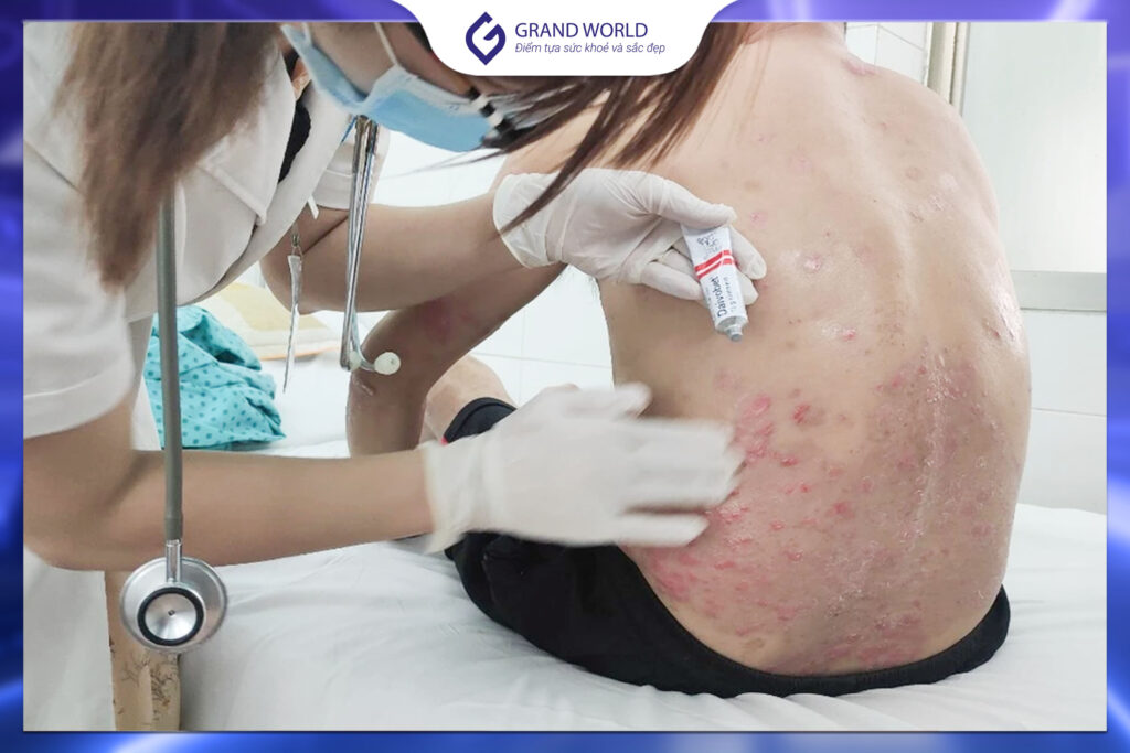 Bác sĩ hướng dẫn người bệnh cách bôi thuốc đúng liều lượng và tần suất