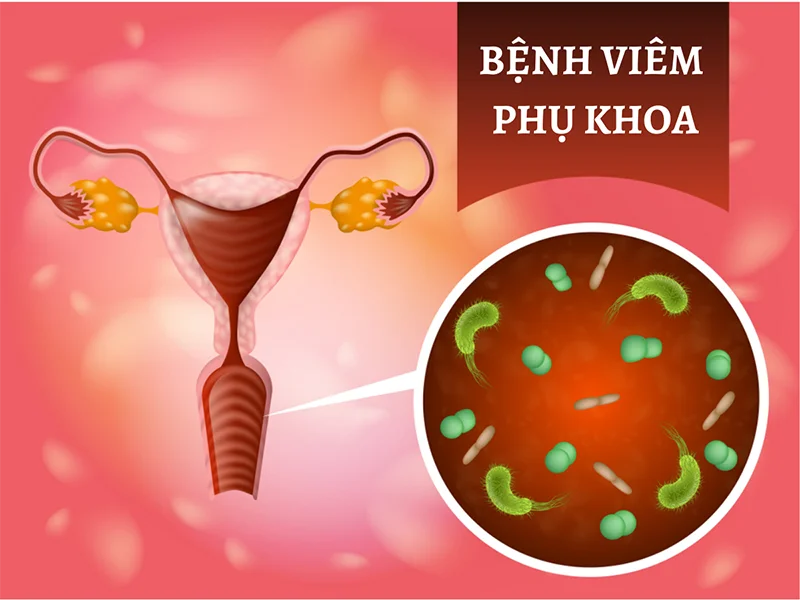 Viêm phụ khoa – tình trạng viêm nhiễm phổ biến ở nữ giới